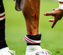Kaki Ronaldo sampai Berdarah, MU Tetap Saja Kalah