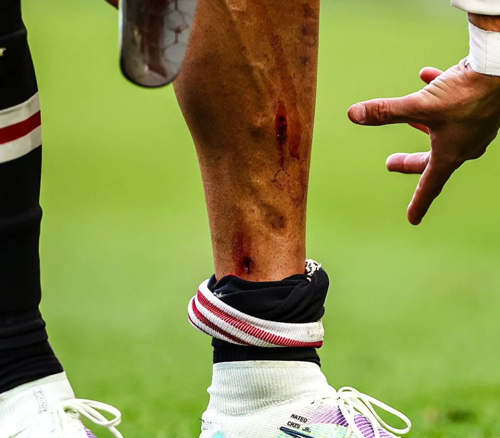 Kaki Ronaldo sampai Berdarah, MU Tetap Saja Kalah